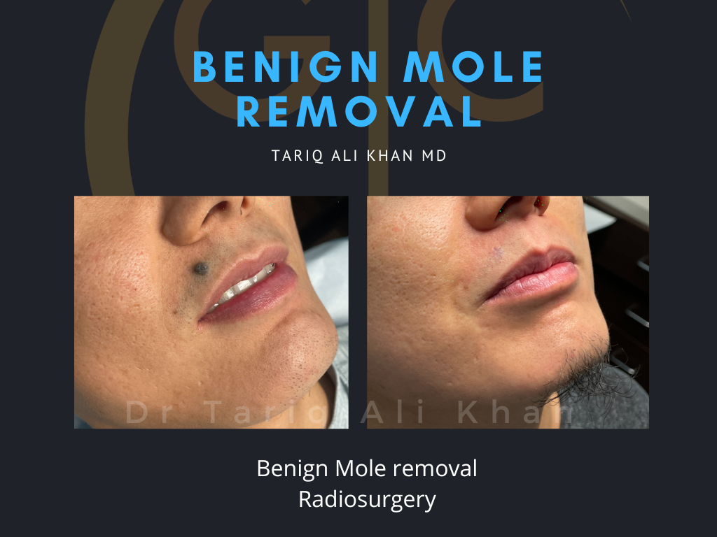 Gentle Care Laser Tustin & Long Beach Before and After picture - Mole Removal